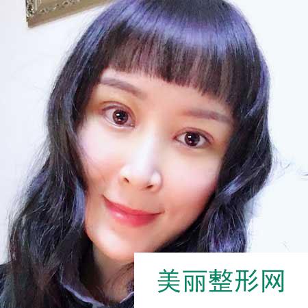 重庆华美整形医院的双眼皮成功案例