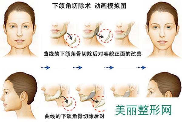 武汉希思特整形医院磨骨全新价格表一览