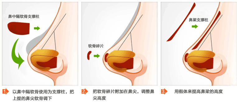 广州阿玛施整形医院隆鼻价格表