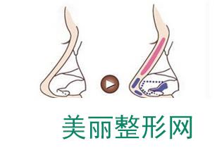 苏州100整形医院隆鼻价格表曝光一览