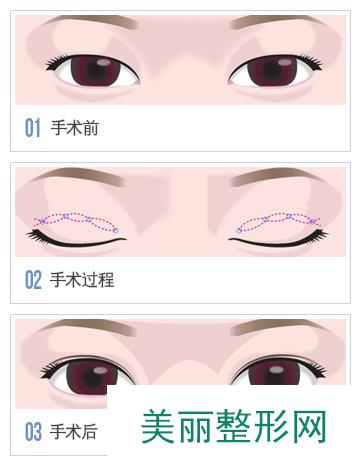 重庆天妃整形医院双眼皮价目表新出炉