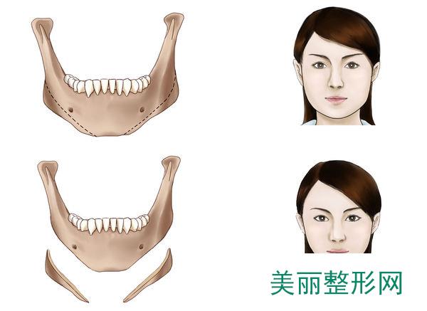 郑州一美整形医院下颌角整形价格表一览更新