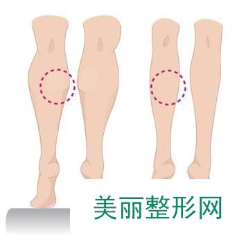 北京高恩世上整形医院小腿吸脂价钱 