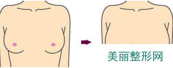 深圳自体脂肪隆胸价格表出炉辣