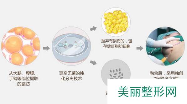 深圳自体脂肪隆胸价格表出炉辣