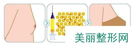 武汉自体脂肪隆胸价格表一览曝光