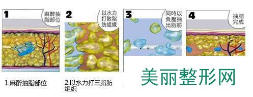 水动力吸脂图解