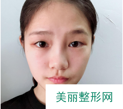 找东莞韩美王仁斌做的双眼皮 55天术后果对比真的较为不错