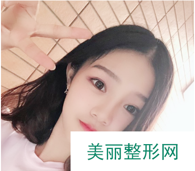 找东莞韩美王仁斌做的双眼皮 55天术后果对比真的较为不错