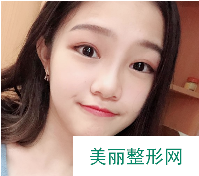 找东莞韩美王仁斌做的双眼皮 55天术后果对比真的较为不错