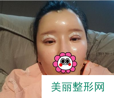 找上海时光李静林做的双眼皮 60天术后果恢复得简直太好了