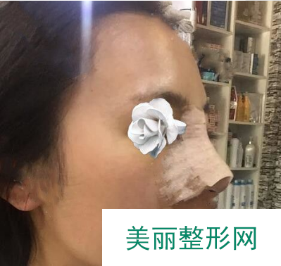 找长沙华美张涛做的鼻子 术后60天果有没有一种小翘鼻的感觉呢