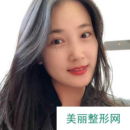 去成都美立方找张娟做全切双眼皮手术后60天