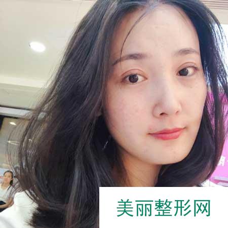 去成都美立方找张娟做全切双眼皮手术后30天