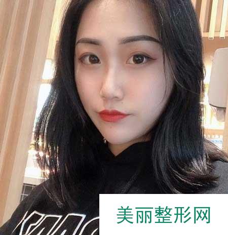 找上海华美徐文龙做完鼻子后，美极了，判若两人