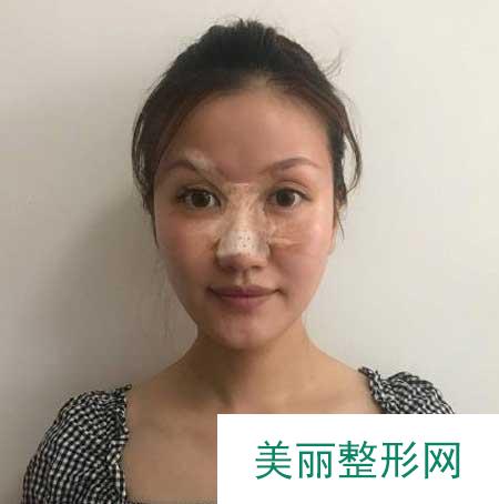 找上海华美徐文龙做完鼻子后，美极了，判若两人