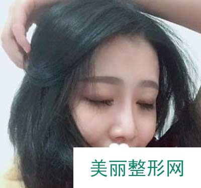 南阳市中心医院做隆鼻手术，术后3个月恢复全过程记录