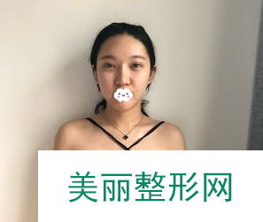 成都美莱吴江山为我做的胸 自体脂肪隆胸90天果对比真的太好了！