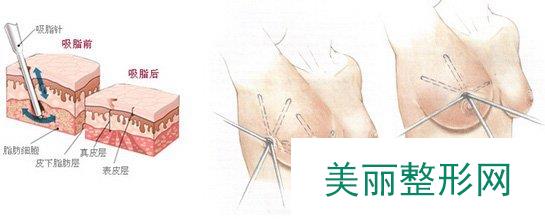 哈尔滨211医院整形丰胸