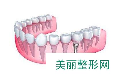 北京种植牙哪里好，北京科尔口腔医院怎么样？