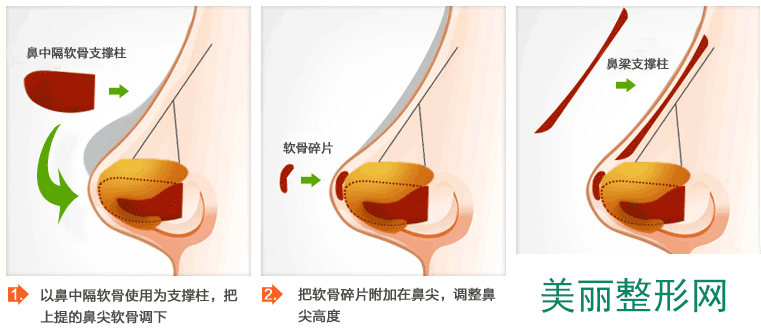 福州比华利整形医院价格价目表热门项目 品质决定平价