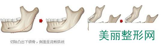 上海，下颌角，磨骨，整形，多少钱