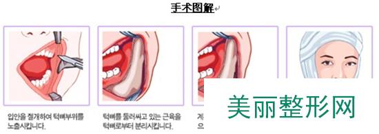 成都，颧骨，颧弓，整形，费用，大概是多少