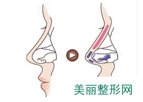 北京，八大处，做隆鼻，果，怎么样，多少钱