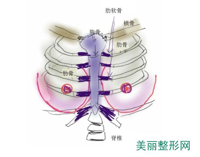 郑州，鸡胸，整形，手术，多少钱