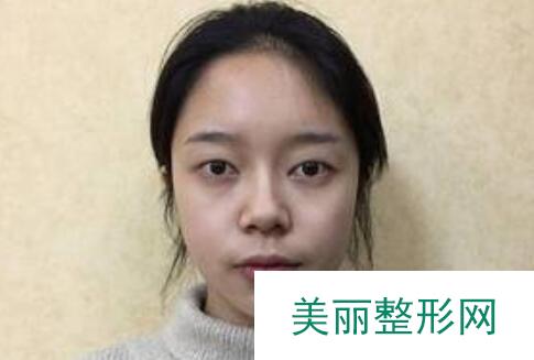 成都格莱丽整形口碑如何？文末放送鼻部手术果反馈