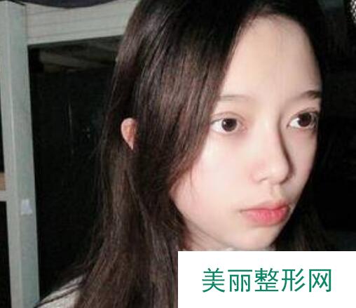 成都格莱丽整形口碑如何？文末放送鼻部手术果反馈