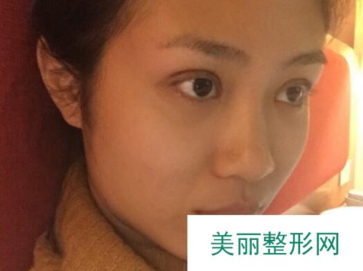 成都美未央整形水平如何？附鼻部手术真实反馈