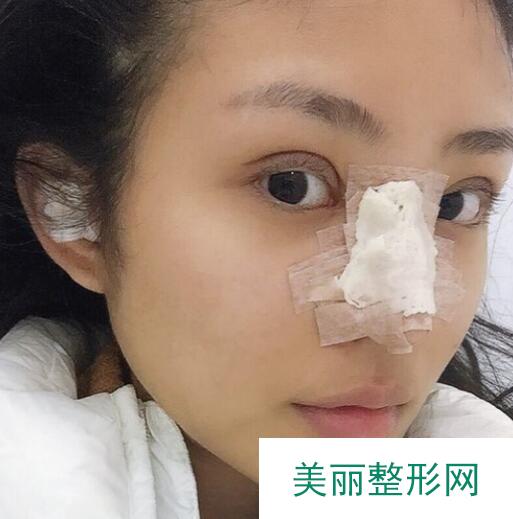 成都美未央整形水平如何？附鼻部手术真实反馈