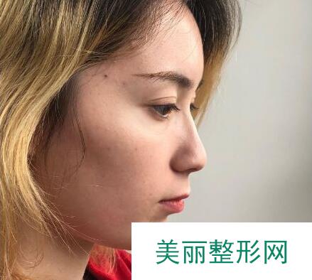 东莞韩美医院做膨体隆鼻果如何？真实案例呈上