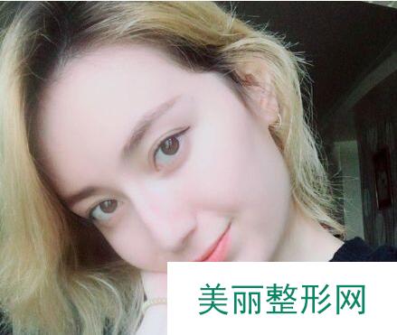 东莞韩美医院做膨体隆鼻果如何？真实案例呈上