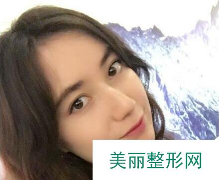 东莞韩美医院做膨体隆鼻果如何？真实案例呈上