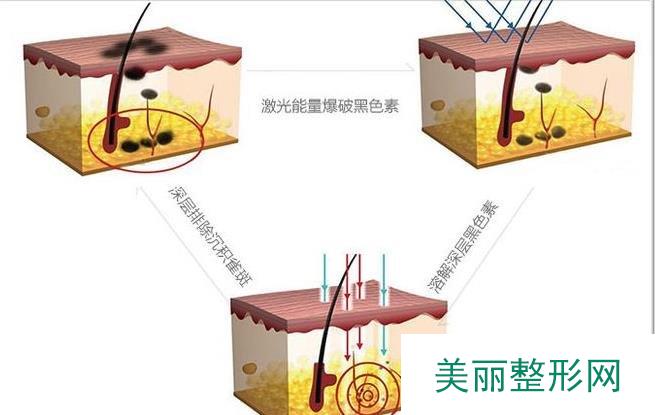 杭州市三院点痣价格表 附点痣原理及注意事项