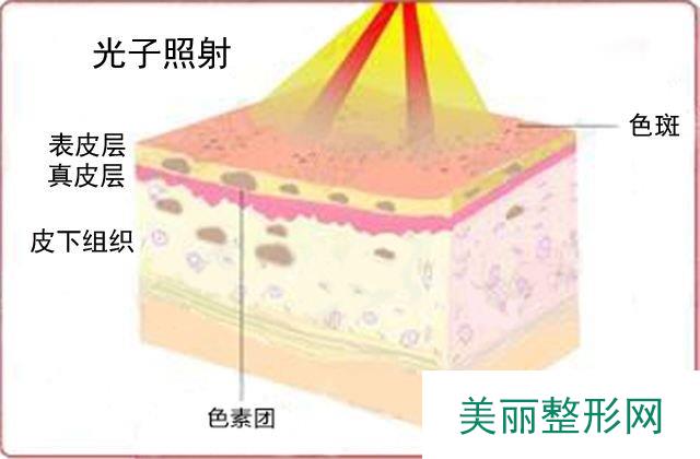 杭州市三医院光子嫩肤价格是多少？果好吗？