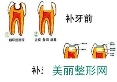 2020湘雅附二补牙费用 口腔美容价格大全