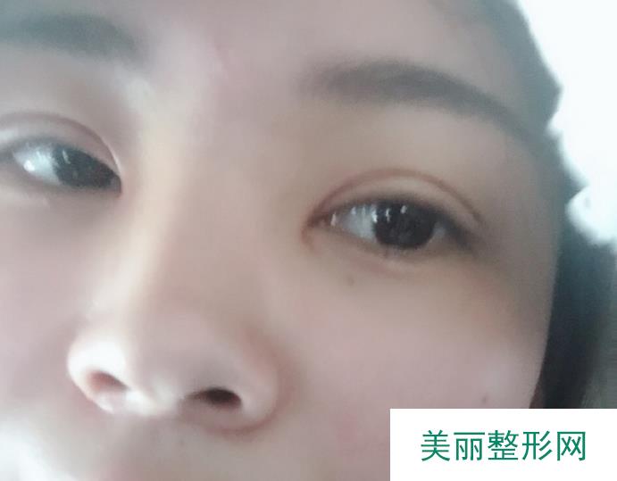 湘雅医院美容科好不好？做过双眼皮的我来评价一下