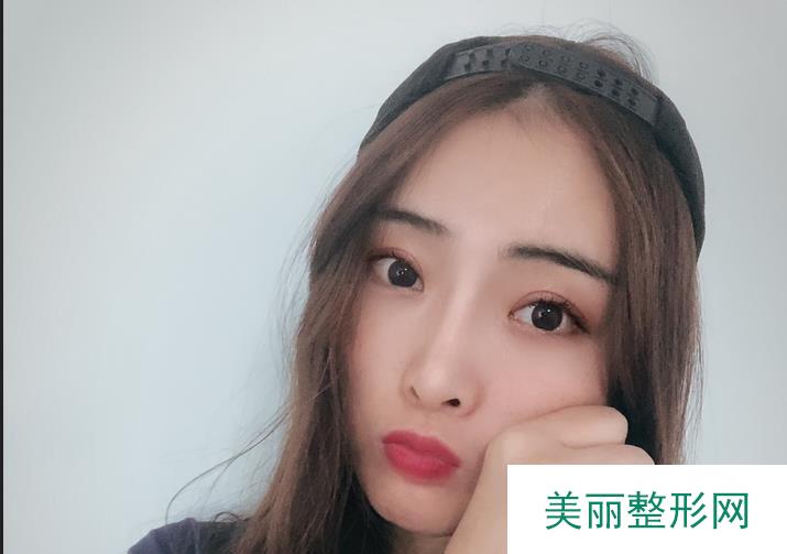 哈医大二院整形美容科任丽虹双眼皮案例 简介口碑