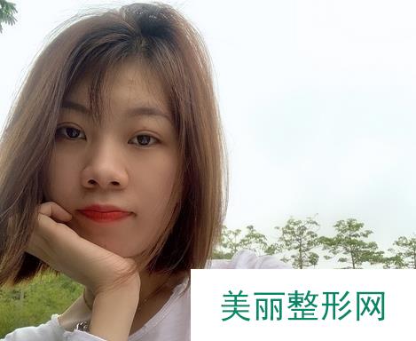 郑大一附院美容科割双眼皮怎么样 附真人案例~