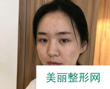 贵港市人民医院整形美容中心怎么样？奉上假体隆鼻案例~