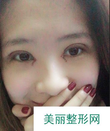 小榄人民医院整形美容怎么样？附双眼皮真实案例~