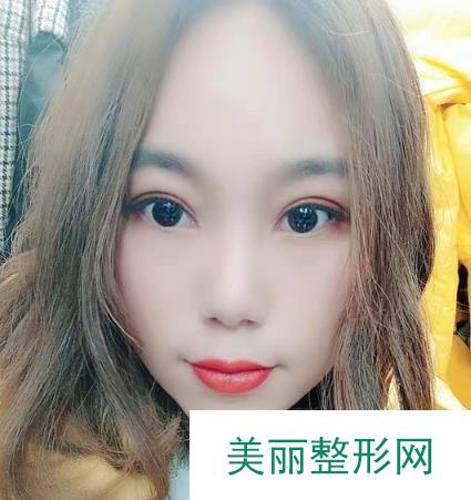 菏泽市立医院整形美容科盖红宇怎么样？附双眼皮案例~