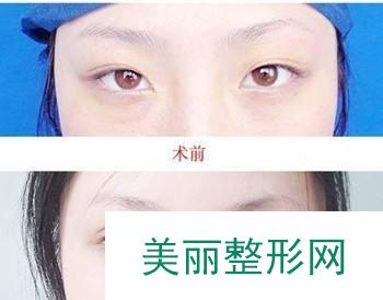 厦门中山医院美容科怎样？价格表+双眼皮案例