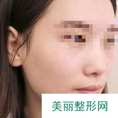 收藏！弋矶山美容科激光祛斑前后对比图，附全新价格表一览~