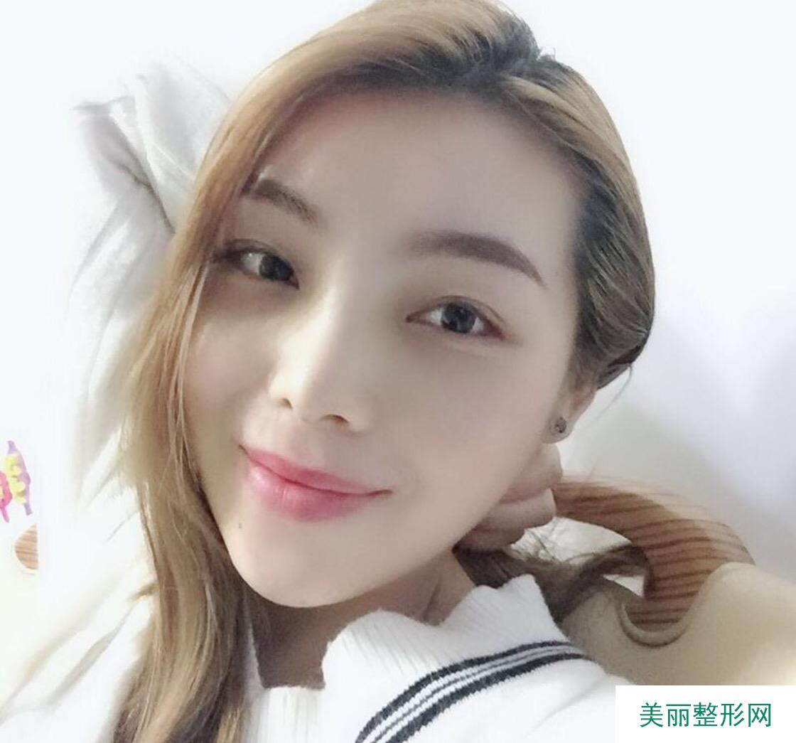 杭州格莱美王小玉医师鼻部手术 30天真人案例分享