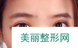 杭州格莱美张霞飞真人双眼皮案例 前后对比分享以及价格详情