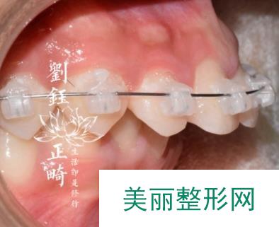 成都亚非牙齿矫正案例